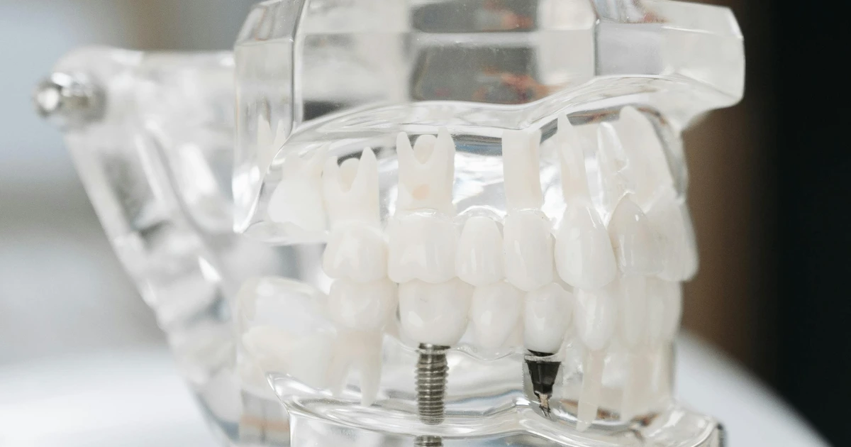 Macromodelo odontológico demonstrando diferentes tipos de implantes e próteses dentárias